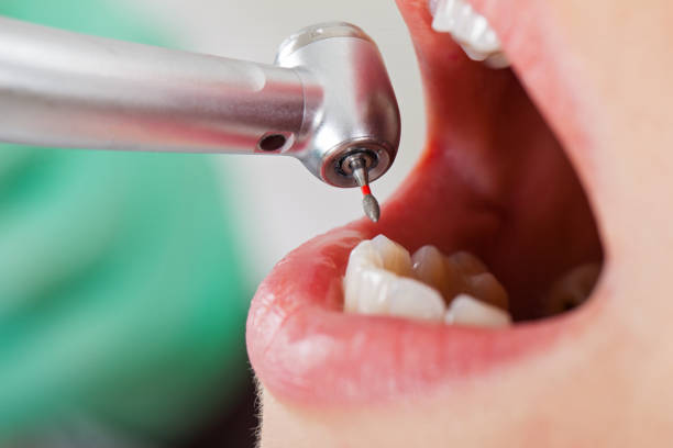 Best Emergency Wisdom Teeth Removal in Richland, PA